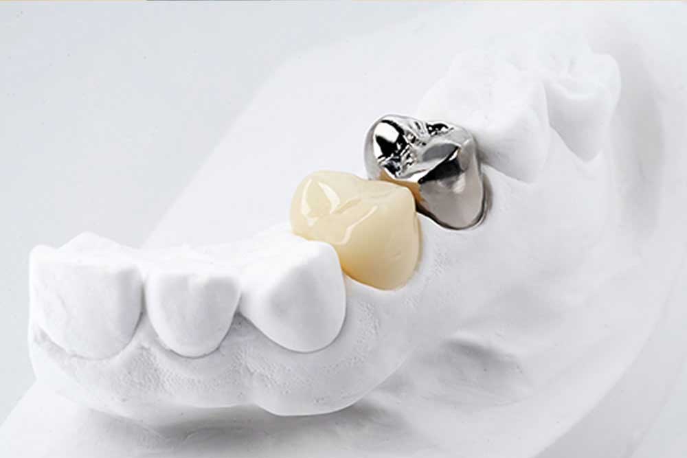 銀歯の虫歯リスク