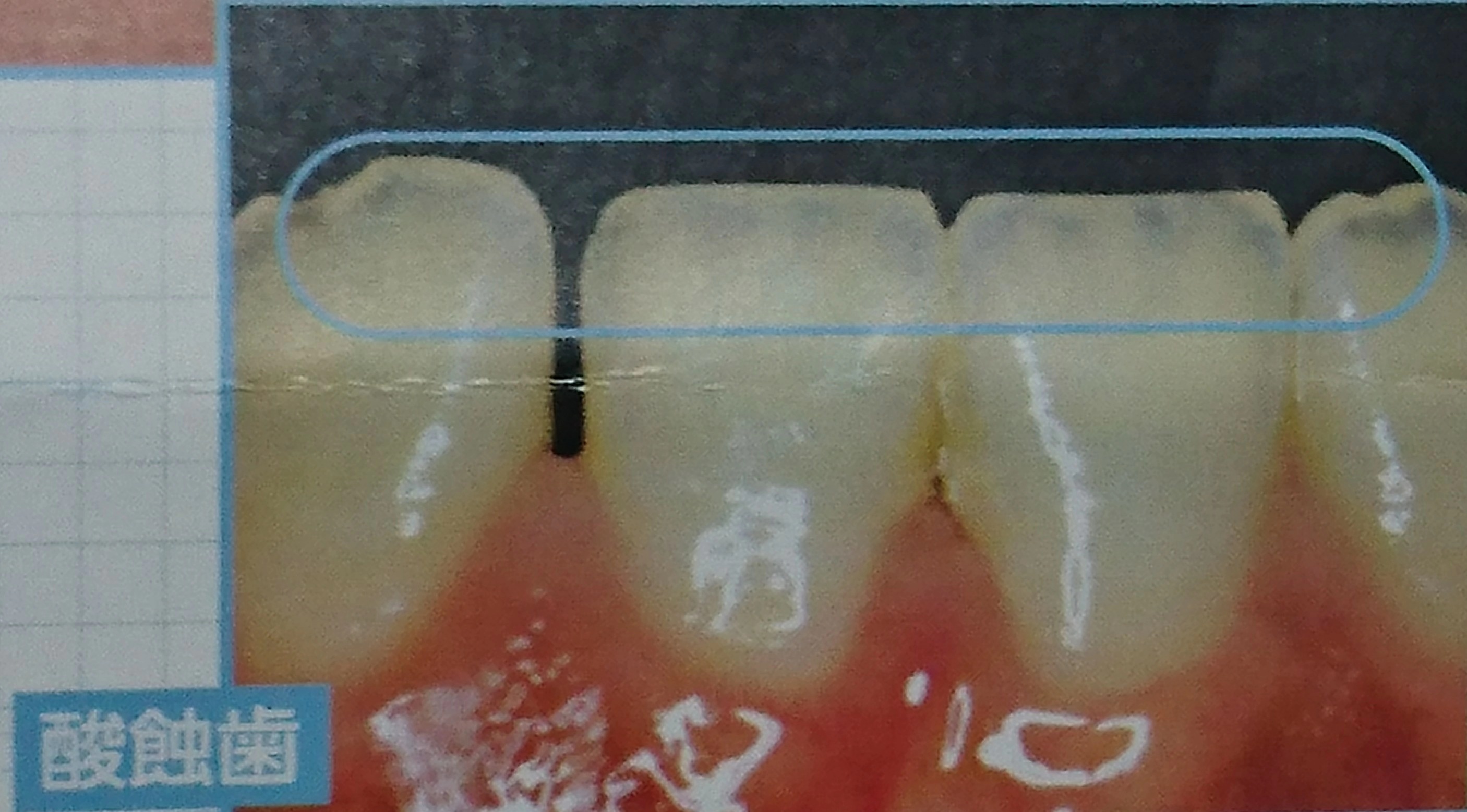 酸蝕歯