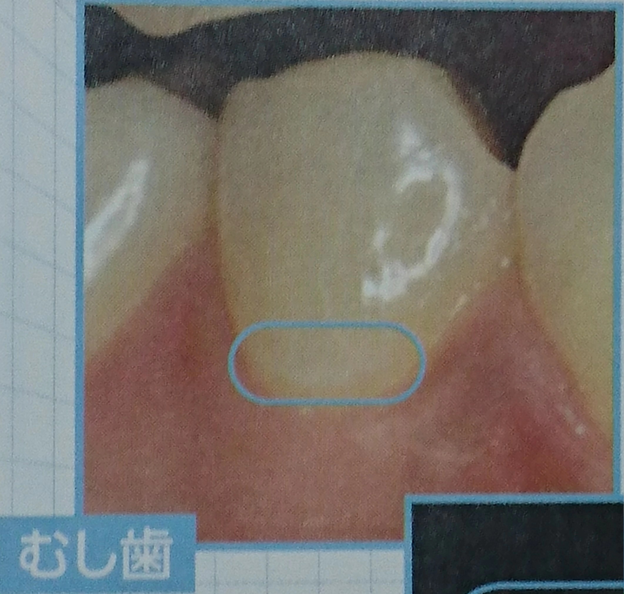 歯が溶ける　虫歯