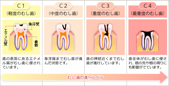 虫歯の進行状況